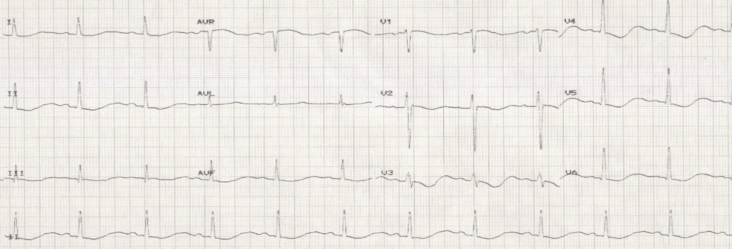 <p>Flattened T waves, prominent U waves, PVCs, depressed ST segments</p>