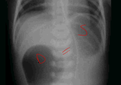 <p>XR sign of duodenal atresia</p>