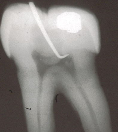 <p>How should you locate and refine the pulp chamber of a mandibular molar when accessing the canal?</p>