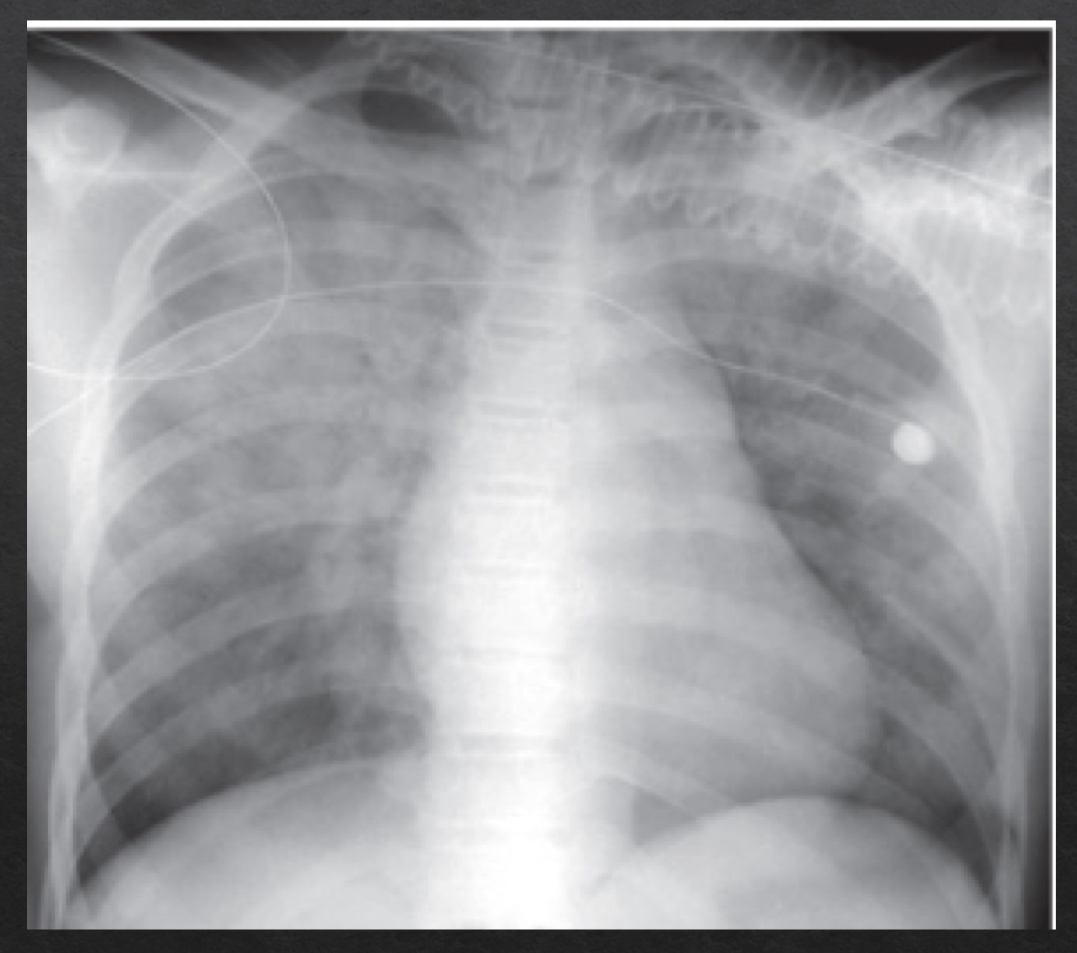<ul><li><p><strong>fluffy, cloud-like, hazy opacities</strong></p></li><li><p>indistinct margins that blend together</p></li><li><p>may contain <strong>air bronchograms</strong></p><ul><li><p>fluid has replaced the air normally surrounding the bronchus, trapping air inside and givngit contrast to be visible</p></li></ul></li><li><p>may demonstrate <strong>silhouette sign </strong></p></li></ul><p></p>