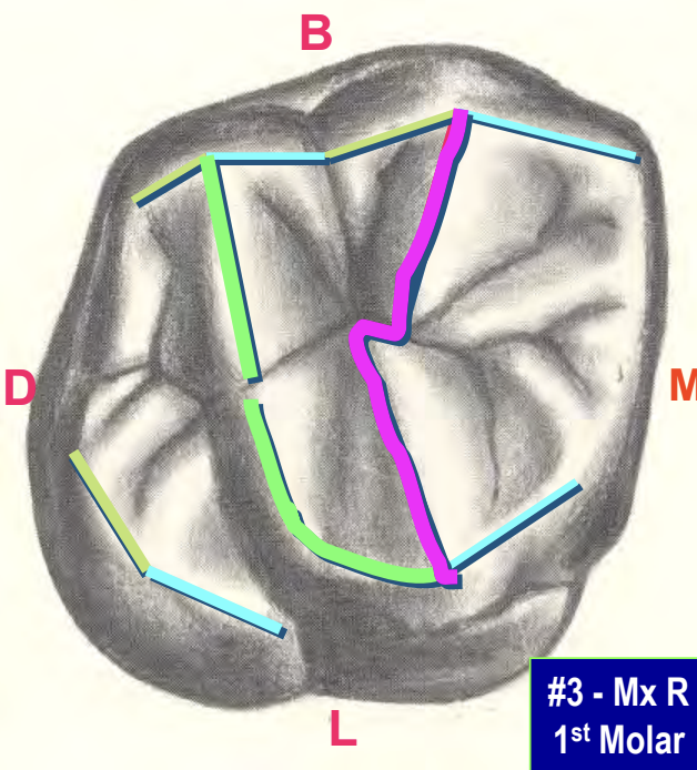 <p>The union of two triangular ridges crossing the surface of a posterior tooth. (Purple)</p>