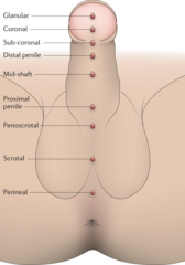 <p>Inability to return retracted foreskin back over the glans, leading to venous congestion and edema.</p>
