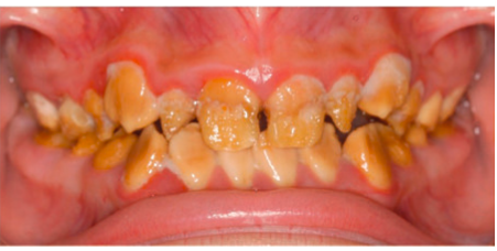 <p><span style="color: red;">low value amount</span> of ameloblast</p><p>produces hypomineralized enamel</p><p>caused by<span style="color: red;"> defective crystal growth and mineralization</span> during the maturation stage of enamel development</p><p><strong>clinical appearance:</strong></p><ul><li><p><span style="color: red;">mottled white-yellow-brown</span> enamel that chips</p></li><li><p>soft</p></li></ul><p></p>