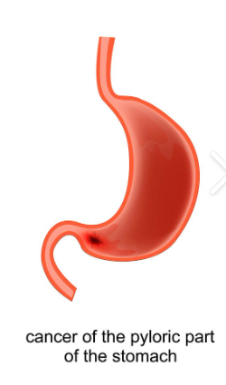 <ol><li><p><span style="background-color: transparent;"> pylorus, or on the lesser curvature side of the antrum</span></p></li></ol><p>Reasoning: </p><p>Distal part of lesser curvature (maybe cuz H pylori) </p>