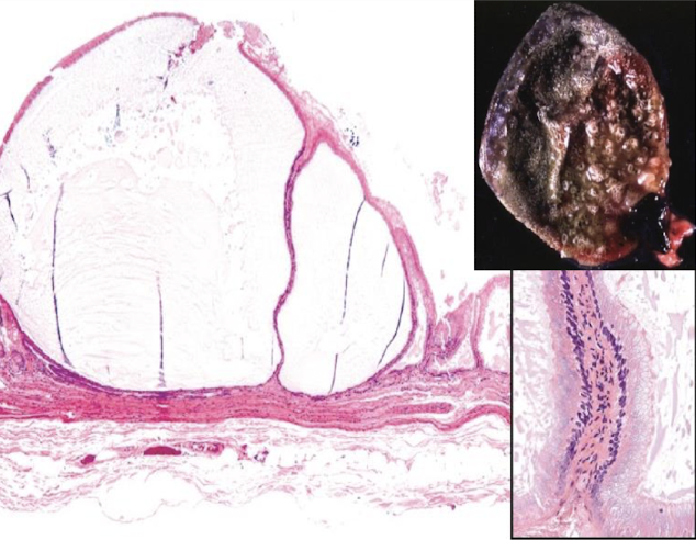 <p>benign proliferative lesion of gallbladder mucosa, characterized by mucin filled epithelial cysts</p>