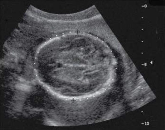 <p>Perpendicular to thalami, 3rd ventricle, and cavum septum pellucidum and tentorium; measurement is made from outer to outer edge of calvarial wall</p>