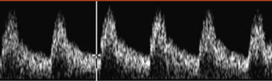 <p>Which resistance pattern is most consistent with this waveform?</p>