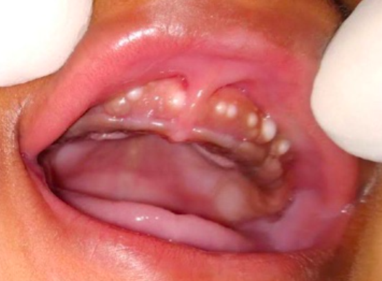<p>due to<span style="color: red;"> remnants of dental lamina</span>, will exfoliate on its own</p><p>an example of nodules that is seen on the <span style="color: red;">buccal alveolar ridge </span>of newborn infants</p>