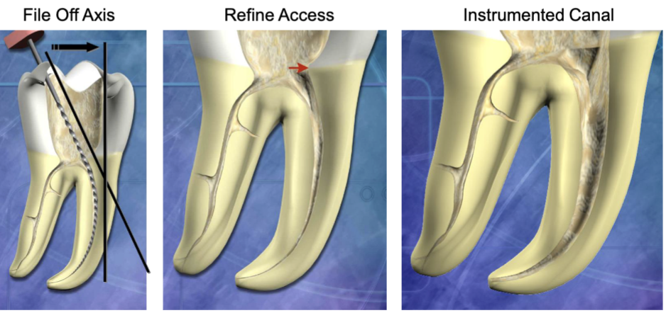 <p>NO: need to open orifice (where red arrow is pointing) to be able to get straight line access </p>