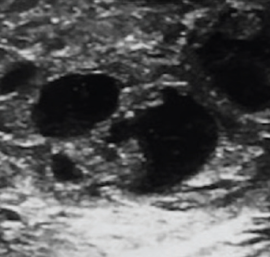 <p>Composed of both tissue and fluid</p>