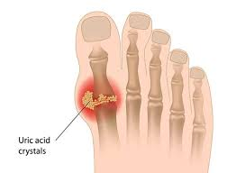 <p>what is gout </p>