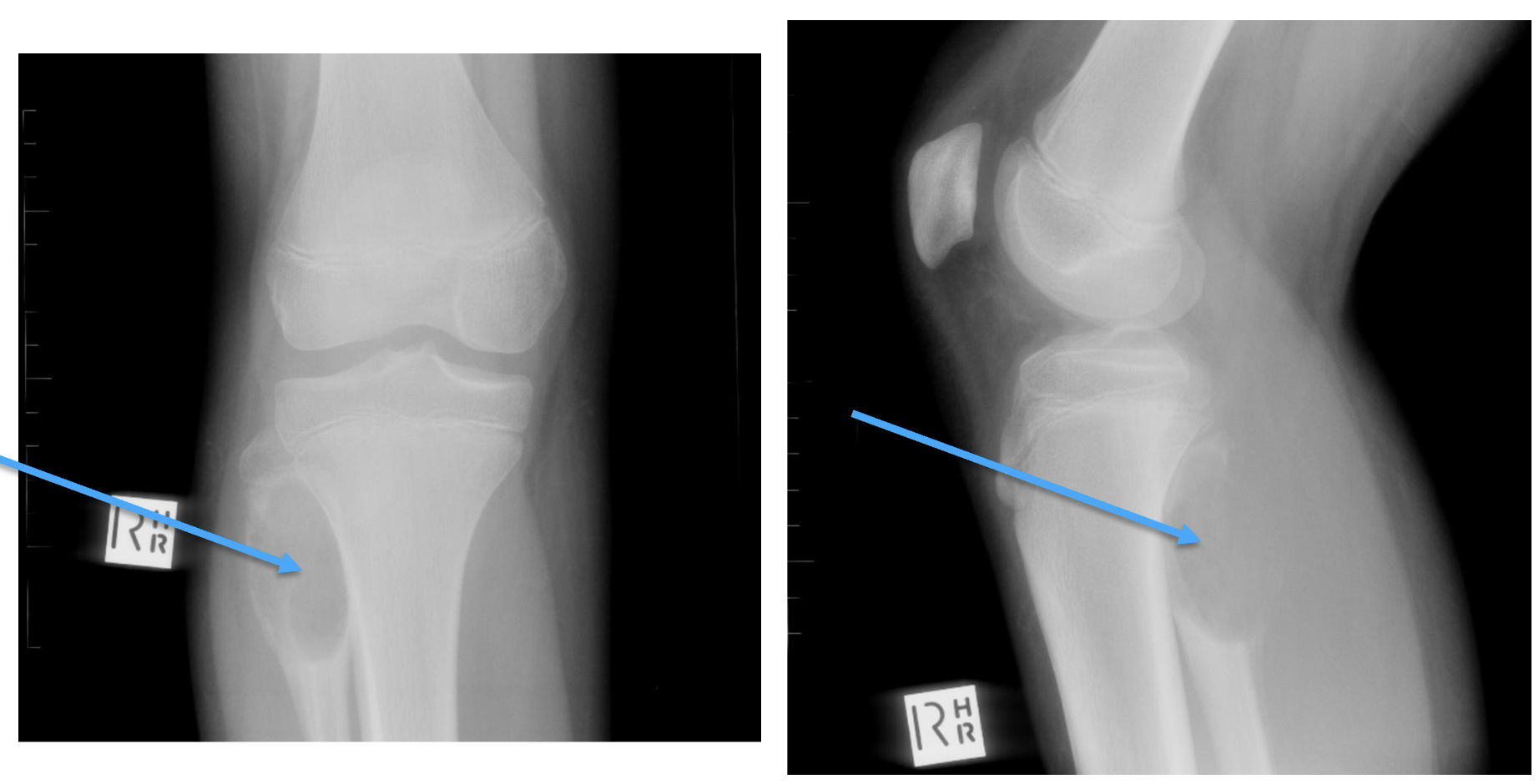 <p>What tumour-like condition is this, what bone is it in and what can be seen?</p>