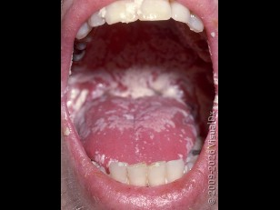 <p>Oral candidiasis (Thrush)</p>