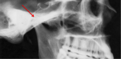 <p>which anatomical landmark:</p><p>- Most superior point of the condyle</p><p>- Should be immediately anterior to Porion</p>