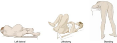 <p>Patient on left side with hips and knees flexed.</p>