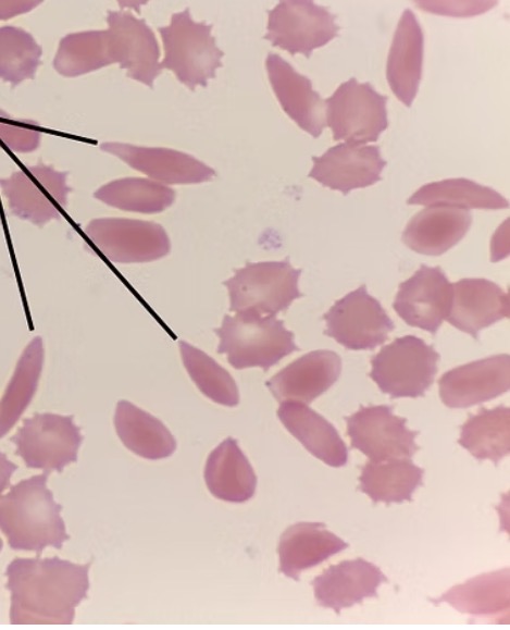 <p><span><span>inherited blood disorder in which hemoglobin molecules are malformed, leading to the breakdown of RBCs that take on a characteristic sickle shape</span></span></p>
