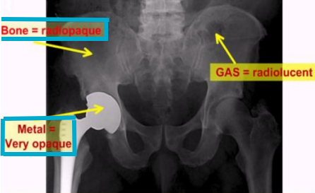 <ul><li><p><span style="background-color: transparent;">FB or structure in which radiation cannot pass through easily</span></p></li><li><p><span style="background-color: transparent;">Blocks radiation → appears white/gray</span></p></li><li><p><span style="background-color: transparent;">Ex: metallic FB</span></p></li></ul><p></p>