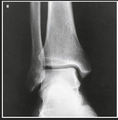 <p>Which aspect of the ankle is best visualized?</p>