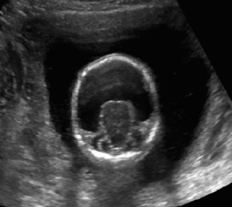 <ul><li><p>mono ventricle </p></li><li><p>fused thalamus</p></li><li><p>no fissure, CSP, CC</p></li></ul><p></p>