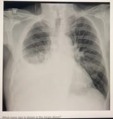 <p>What name sign is shown in the image above:</p><p>a. batwing sign </p><p>b. cat under the rug sign </p><p>c. meniscus sign</p><p>d. air bronchogram sign</p>