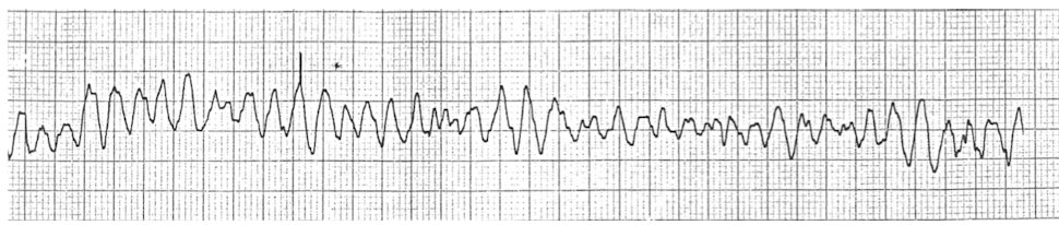 <p>while exercising a patient on the treadmill, the PT notices the ECG as shown in the image. What should their INITIAL response be? </p><p>a. continue walking at same intensity </p><p>b. continue walking at lower intensity </p><p>c. stop the treatment and monitor ECG for 10 minutes </p><p>d. activate the emergency system or call 911 </p>