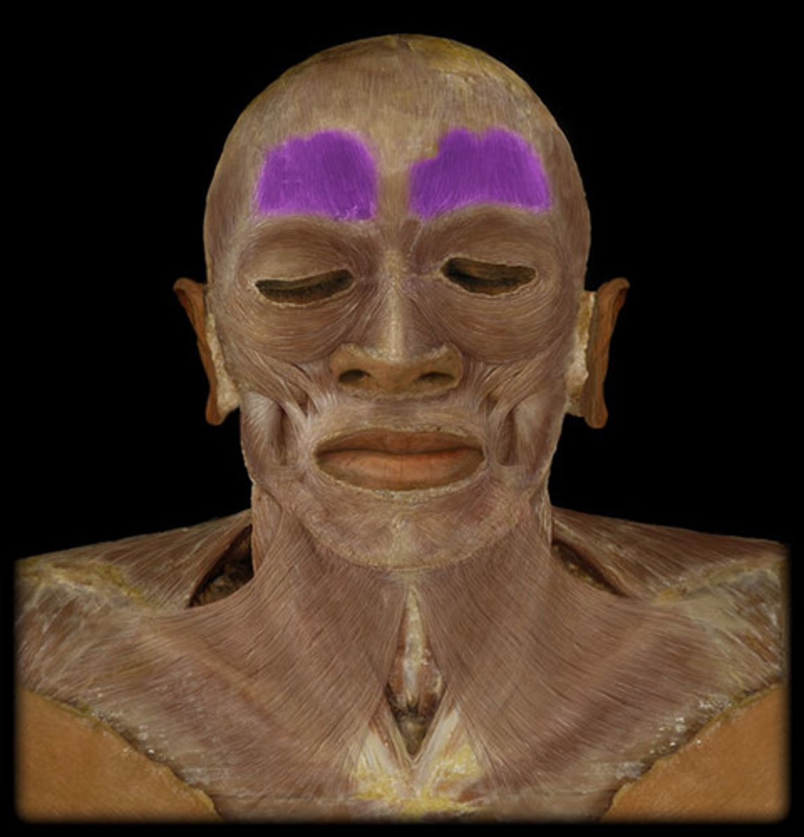 <p>Region: </p><p>Face</p><p>Action: </p><p>Raises eyebrows, wrinkles forehead </p><p>Innervation: </p><p>Facial nerve (CN VII) </p>