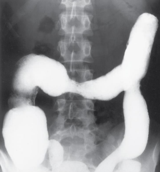 <p>Chronic idiopathic inflammatory disease of the colon.</p>