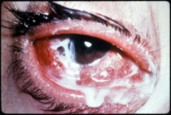 <p>- Syphilis</p><p>- Chlamydia </p><p>- Pediculosis </p><p>- Gonorrhea (image)</p><p>- HIV</p><p>- Herpes (HSV)</p><p>- Hepatitis B</p>