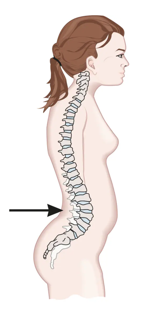 <p>the stomach is too anterior and the buttocks are too posterior, causing exessive stress on the lumbar region of the back</p><ul><li><p>swayback</p></li></ul><p></p>