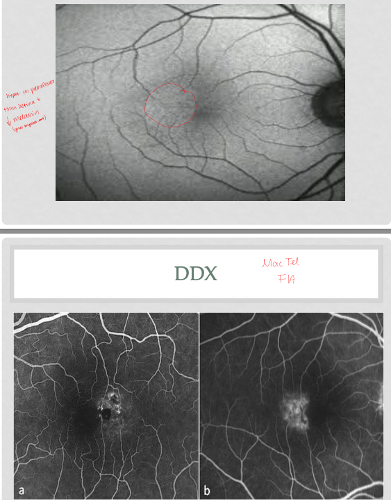 <p>parafoveal grey/green; retinal thinning and decrease melanin</p><p>telangiectasia in fundus; vessels go into macula and bend at 90 degrees</p><p>crystalline deposits (damaged Muller cells); effects outer and inner layers</p><p>hyperplasia of pigment </p><p>OCT: inner cavitation most common; ILM drap sign; can have outer cavitation</p><p>FAF: hyper parafovea, thin retina and decrease melanin</p><p>FA: telangiectasia leakage </p>