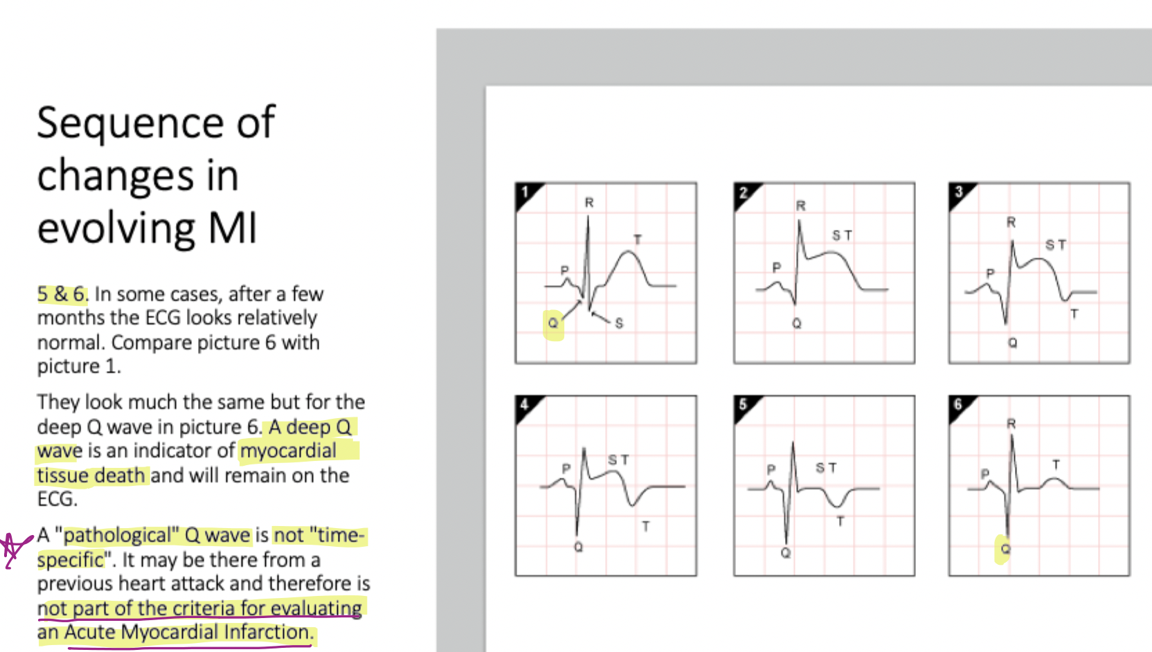 <p>Permanent <strong>necrosis</strong> &amp; <strong>fibrosis</strong> (myocardial tissue death)</p><ul><li><p><strong>T wave inversion</strong></p></li><li><p><strong>not time specific —</strong><u>not</u> a criteria for evaluating a<em>cute myocardia infarction</em></p></li></ul><p></p>