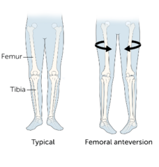 <p>Rotation deformity of femoral head in acetabulum (anteversion or retroversion)</p><p>Part of the process that causes in-toeing</p><p>Thought to be related to intrauterine position</p>
