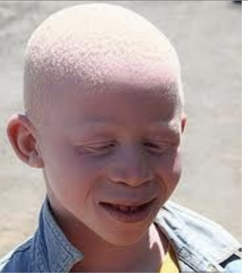 <p>A 7-year-old male of Nigerian descent is evaluated by a pediatrician for his first wellness check. The office collects photos of all new patients and the photo is shown in the included image. The most likely gene mutation in this child is in a gene that codes for:</p>