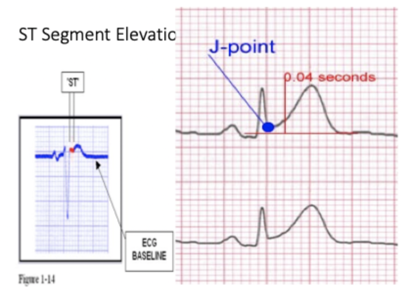 <p>To ensure measurement is taken after the point <strong>where the QRS meets the baseline</strong></p>