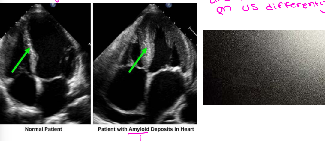 <p>The myocardium has a bright, speckled appearance caused by protein deposits reflecting ultrasound waves differently.</p>