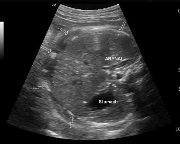 <p>abdominal calcifications</p><ul><li><p>bowel perforation</p></li></ul><p></p>