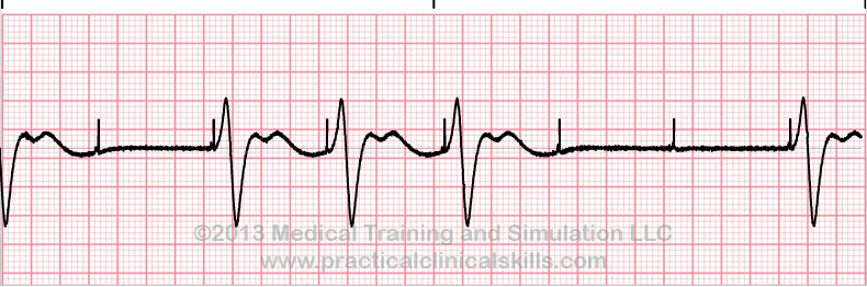 <p>When there are pacer spikes without a QRS complex</p>