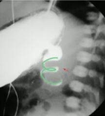 <p>upper GI seriies finding of malrotation with midgut volvulus</p>