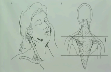 <p>Can be damaged due to acute injuries</p><p>Affects sternocleidomastoid and trapezius muscle—leading of lack of head movement and shoulder joint elevation</p>