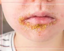 <ul><li><p>starts as <span style="color: rgb(27, 180, 47);"><strong>minor cuts, insect bites, broken skin</strong></span> around mouth/nose</p><ul><li><p>sores/blisters <span style="color: rgb(153, 132, 32);"><strong>rupture→ oozing and crusts</strong></span> over</p></li></ul></li></ul><p></p>