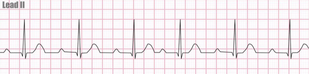 <p>the image shown depicts what cardiac arrhythmia?</p>