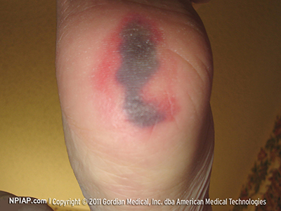 <p>What pressure injury does this depict?</p>