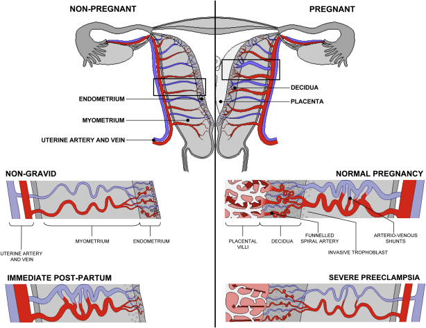 <ul><li><p>defective early-pregnancy remodeling of maternal spiral arteries</p></li><li><p>→ high resistance blood vessels</p></li><li><p>reduced uteroplacental perfusion</p></li><li><p>chronic fetal hypoxia</p></li><li><p>restricted fetal growth</p></li></ul><p></p>