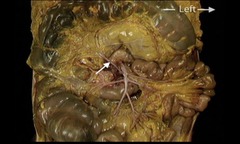 <p>In this anterior view of the contents of the abdomen, the greater omentum and transverse colon have been reflected superiorly. Identify the artery indicated by the arrow.</p><p>Ileo-colic</p><p>Intestinal artery</p><p>Middle colic</p>