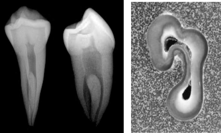 <p>14% of mandibular 1st premolars may exhibit a “C’ shaped anatomy with how many foramen and apices</p>