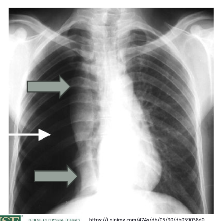 <p>since there is air in the pleural space, see a collapsed lung and increased radiolucency on the affected side of the chest x-ray- structures will be pushed away from the affected side and a shift of the mediastinum </p>