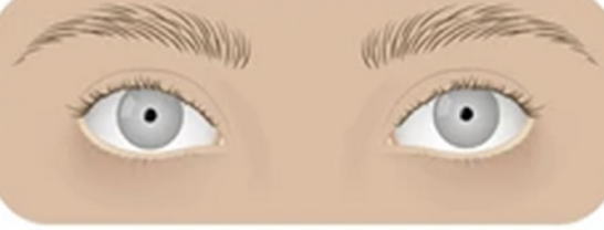 <p>constricted pupil </p>