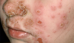 <p>collection of dried serum and cellular debris</p><p>a scab</p>