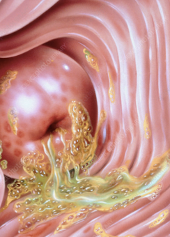 <ul><li><p>frothy, malodorous, green/yellow discharge</p></li><li><p>strawberry spots on cervix </p></li></ul><p></p>