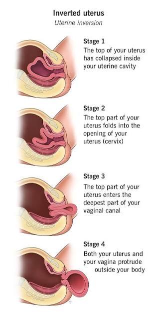 <p>Life-threatening complication where uterus flips inside out</p><ul><li><p><span style="color: rgb(0, 0, 0);"><strong><mark data-color="red" style="background-color: red; color: inherit;">NO PULLING ON CORD unless separation is certain</mark></strong></span></p></li></ul><p><span style="color: red;"><strong>RISK FACTORS</strong></span></p><ul><li><p><strong>Fundal pressure</strong> <strong>or improper fundal massage</strong> → Never apply fundal pressure if fundus is firm o</p></li><li><p><strong>Short cord </strong>→ Can pull the placenta out before its ready, pulling on uterus</p></li><li><p><strong>Cord traction</strong>→ Pulling cord by force. Placenta is ready when cord is lengthening outside the vagina &amp; will have spurts of blood</p></li><li><p>Uterine Atony</p></li><li><p>Fibroids</p></li><li><p>Multiples </p></li><li><p>Hx of placenta accreta/increta → Part of placenta grows<u> inside</u> uterus, instead on being attach to it. </p></li><li><p>Hx of Past inversion</p></li></ul><p></p><p><span style="color: red;"><strong>SIGNS &amp; SYMPTOMS</strong></span></p><ul><li><p>Hemorrhage (94% of cases)</p></li><li><p>Shock</p></li><li><p>Pain</p></li></ul><p></p><p><span style="color: red;"><strong>TYPES</strong></span></p><ul><li><p>Partial or complete </p></li></ul><p></p><p><span style="color: red;"><strong>TREATMENT</strong></span></p><ul><li><p>Lactated Ringer’s &amp; blood products → treat shock; must have IV access</p></li><li><p>Fundal repositioning after placenta separation</p><ul><li><p>Give MgSO4 &amp; analgesia to relax uterus (discontinue after repositioning)</p><ul><li><p>MgSO4 relaxes uterine muscle, uterus must be completely relaxed to put back in place</p></li></ul></li></ul></li><li><p>Oxytocic medications &amp; bimanual compression</p></li><li><p>Antibiotic therapy</p></li></ul><p></p>